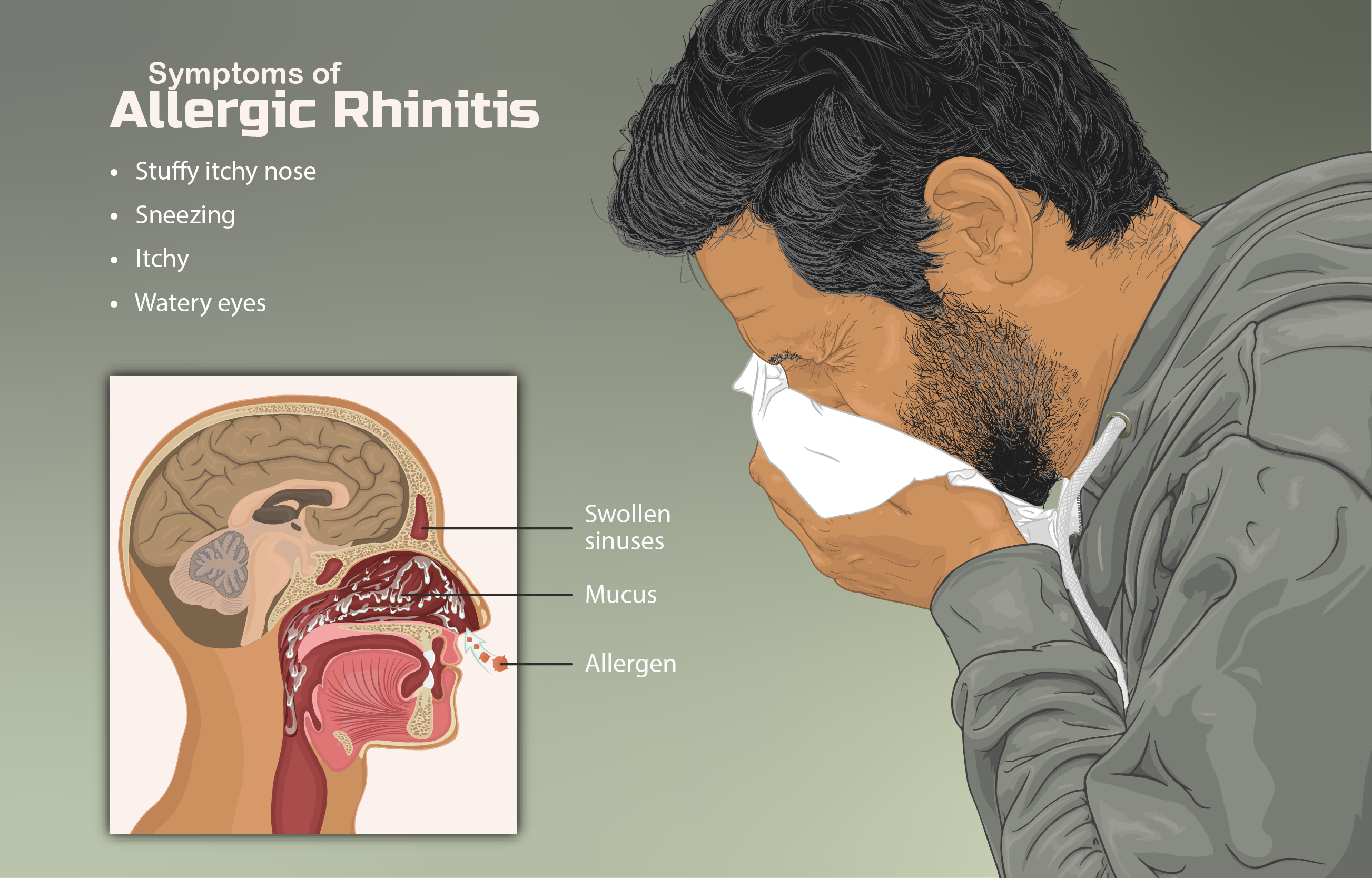 Allergic rhinitis (hay fever)